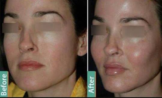 Before and after