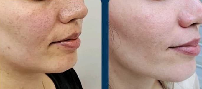 Before and after
